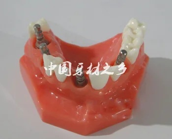 Continental implantas danties modelis su Sodinimo nagų mokymo aparatas, nemokamas pristatymas